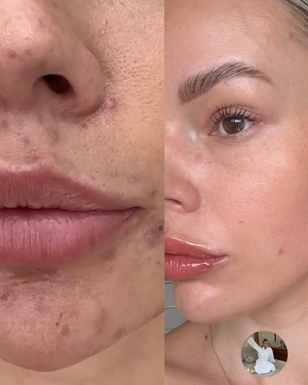Before and after skin transformation showing clearer, healthier skin